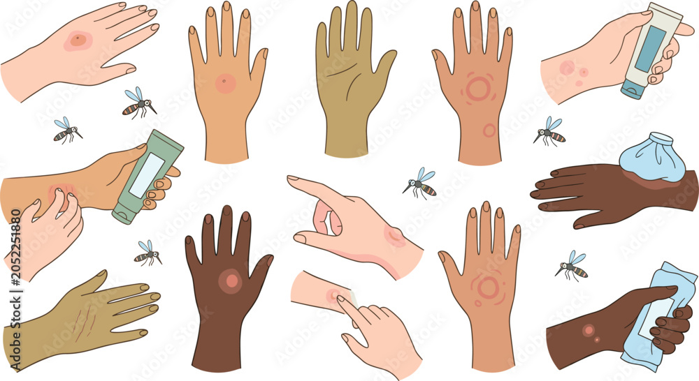 Fototapeta premium Insect Bite and Skin Rash Medical Vector Set with Mosquitoes Hand Swelling Inflammation Allergy Treatment Cream and Ice Pack Icons