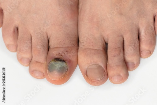 A close-up photograph of a human foot with a severe toenail infection. The toenail of the big toe is thickened, discolored, and partially detached because of a broken bone