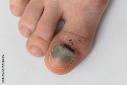 A close-up photograph of a human foot with a severe toenail infection. The toenail of the big toe is thickened, discolored, and partially detached because of a broken bone