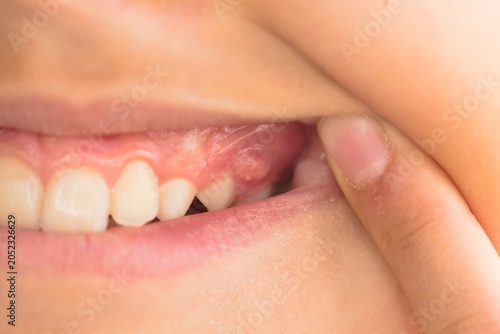 A close-up photograph of a child's open mouth, revealing a dental fistula - fistula dentalis