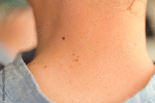 A close-up photograph of a light-skinned man's neck and upper chest, showcasing a series of small, circular moles scattered across the skin. 