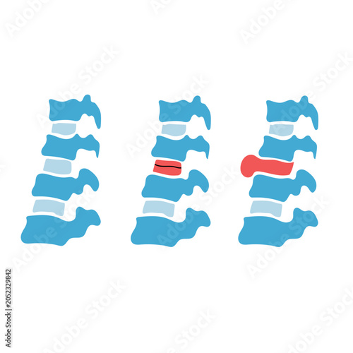 Billede på lærred Spinal disc degeneration progression showing herniation stages