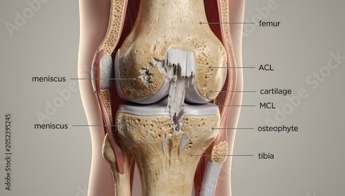 3D x-ray arthritic knee with meniscus tear, tendons, ligaments, bones, and patella on clinical background.