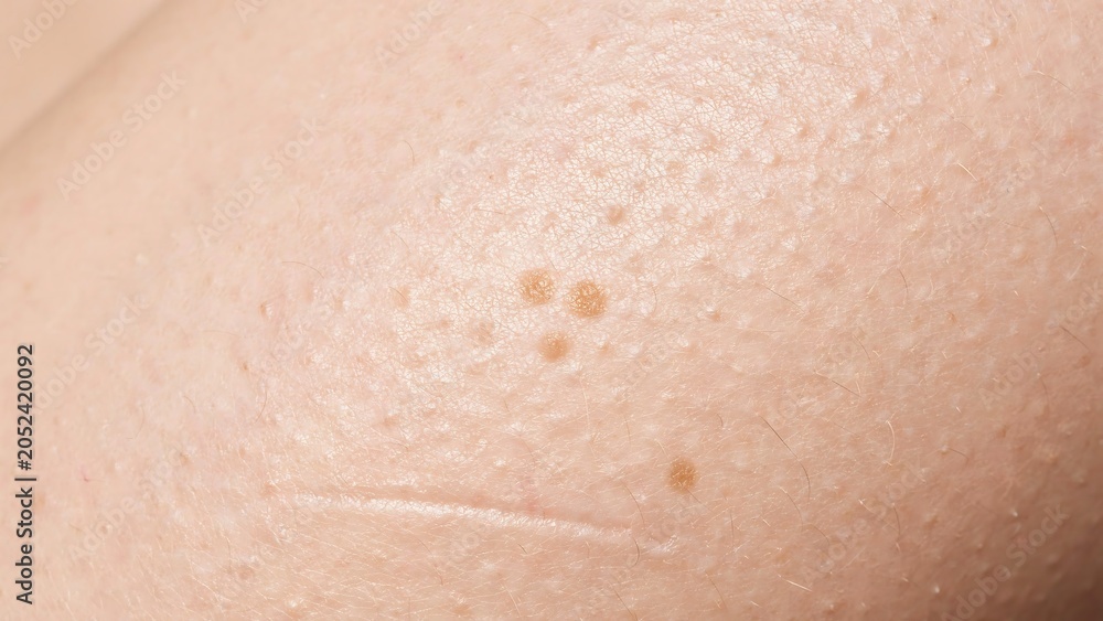 Fototapeta premium Close up of human skin with moles and freckles on surface