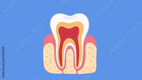 animation root canal inflammation inside human tooth