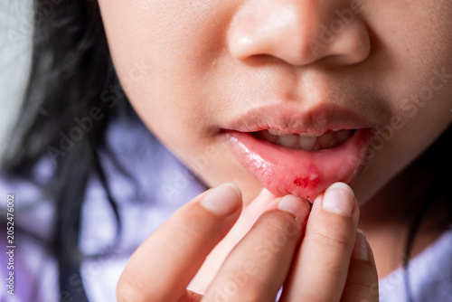 Fotografie Close-up of a parent's hand gently checking a painful mouth ulcer or canker sore on a child's lower lip