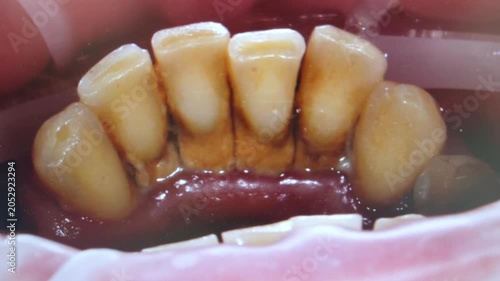 Teeth with heavy tartar buildup and bleeding gums, dental pathology close up