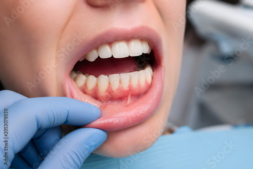 Labial Frenectomy and Periodontal Evaluation – Lip Tie Treatment, Gum Health & Pediatric Dental Care