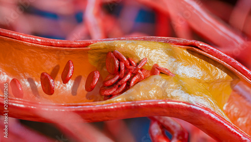 Cholesterrol or Atherosclerotic Plaque in blood vessels, Blocked vessel stroke, Thickened Arteries and Veins, Coronary, fat buildup clogging, Atherosclerosis or atheromatous Hyperlipidemia, 3d render