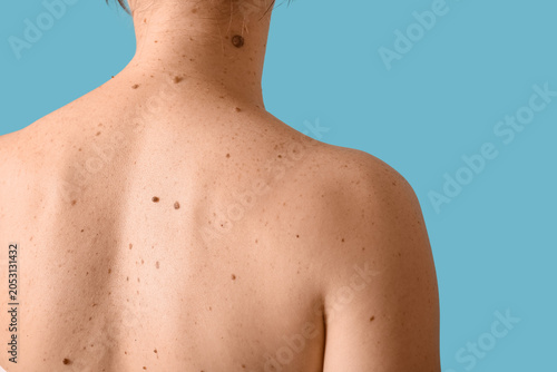Fotografi Woman with moles on her back against blue background, closeup