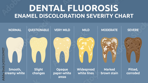 Schilderij op canvas Dental Fluorosis Enamel Discoloration Severity Chart