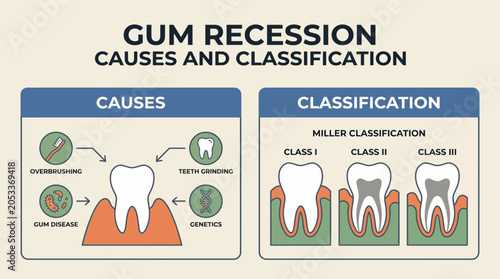 Fotografie Gum Recession Causes and Classification Illustration