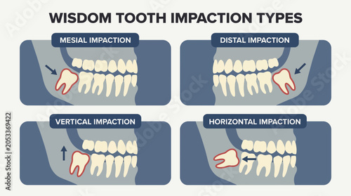 Foto Wisdom Tooth Impaction Types Diagram