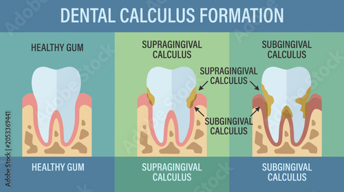 Bild auf Leinwand Dental Calculus Supragingival Subgingival Formation