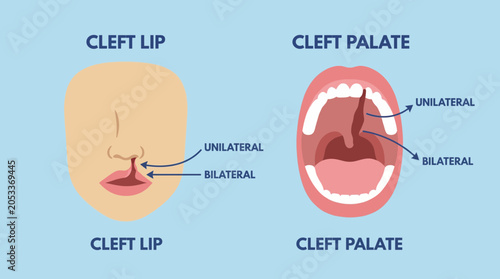 Foto Cleft Palate and Lip Congenital Defect Anatomy