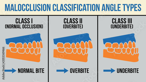 Tableau sur toile Malocclusion Classification Angle Types Diagram