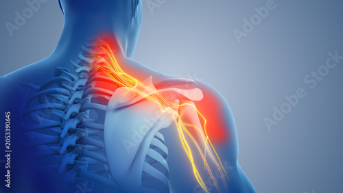 Neck Nerve Irritation Triggering Shoulder Pain