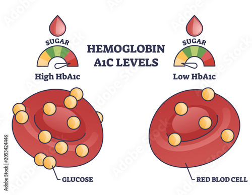 Cuadro en lienzo Hemoglobin A1c levels visual compares high vs low glucose binding on red blood cells, red blood cell, glucose dots, and sugar gauge convey diabetes monitoring concept, transparent background