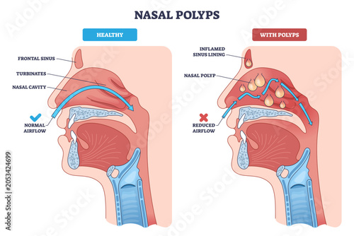 Slika na platnu Nasal polyps brief overview showing healthy vs polyp-filled sinuses, with airflo