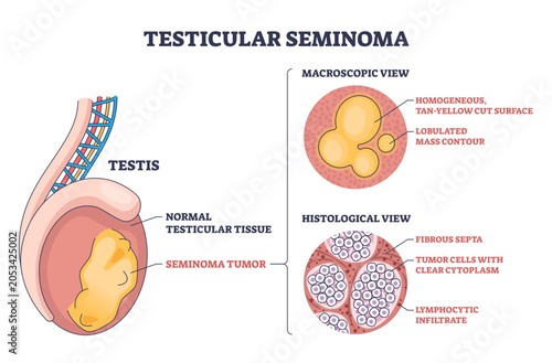 Bild auf Leinwand Testicular seminoma diagram explains cancer in the testis, showing a lobulated t