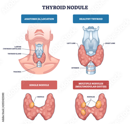 Tableau sur toile Thyroid nodules diagram compares healthy gland and nodule types, showing thyroid