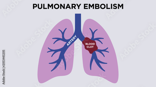 Foto Pulmonary Embolism Blood Clot Blocking Lung Artery