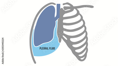 Tableau sur toile Pleural Effusion Fluid Accumulation Around Lung Surface