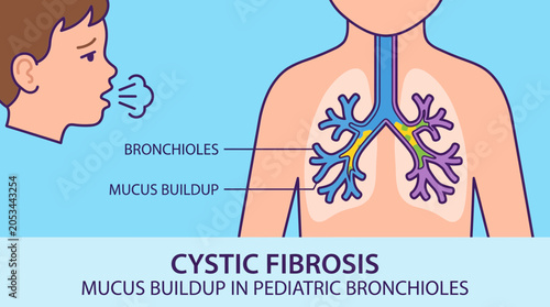 Canvastavla Cystic Fibrosis Mucus Buildup in Pediatric Bronchioles