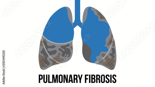Bild auf Leinwand Pulmonary Fibrosis Scarring and Stiffening of Lung Tissue