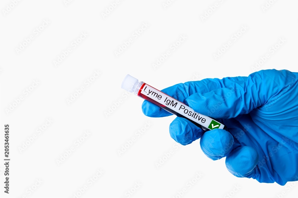 Fototapeta premium Lyme Disease Positive Blood Test Tube