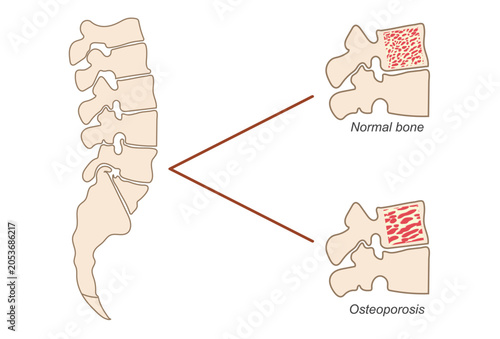 Medical vector illustration comparing a healthy spine and an osteoporosis affected spine.
