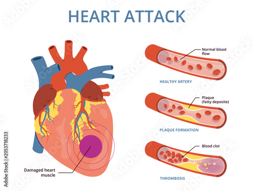 Bild auf Leinwand Heart attack