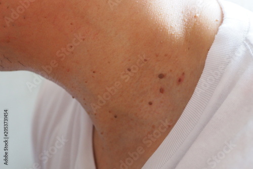Bild auf Leinwand Many skin tags or Acrochordon on the neck They are small soft and common benign