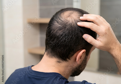 Man Examining Thinning Hair in Mirror – Baldness, Hair, Loss, Male, Pattern, Aging, Health, Scalp, Genetics, Concern

