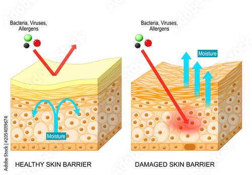 Skin barrier. Cross section of epidermis. Comparison of healthy and damaged skin barrier layers.