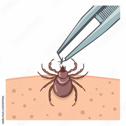 Tick Removal with Tweezers from Skin