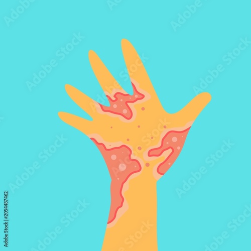 Tableau sur toile Itchy skin diseases in isolated background