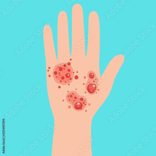 Φωτογραφία Itchy skin diseases in isolated background