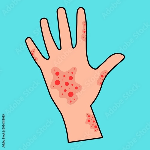 Billede på lærred Itchy skin diseases in isolated background