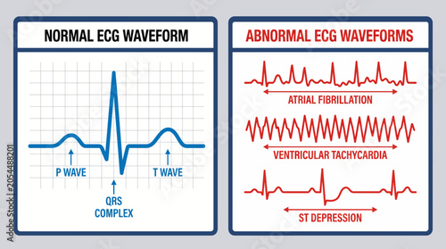 Photos Electrocardiogram ECG Waveform Normal Versus Abnormal Comparison