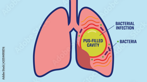 Bild auf Leinwand Lung Abscess Pus-Filled Cavity from Bacterial Infection