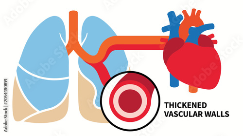 Photos Pulmonary Arterial Hypertension Thickened Vascular Walls