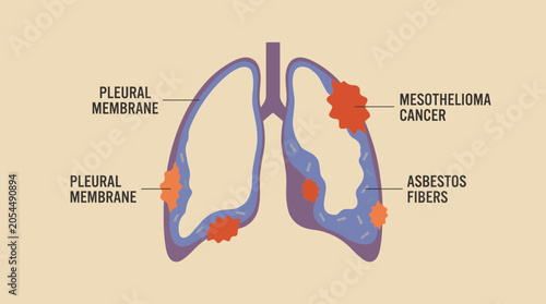 Slika na platnu Mesothelioma Cancerous Pleural Membrane from Asbestos Exposure