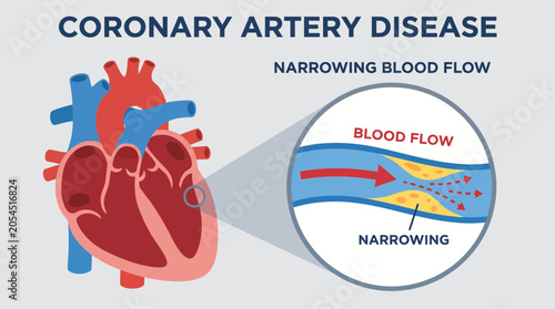 Fotografi Coronary Artery Disease Narrowing Blood Flow Vector
