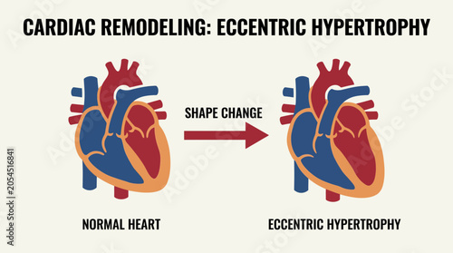 Tablou pe pânză Cardiac Remodeling Eccentric Hypertrophy Shape Change Vector
