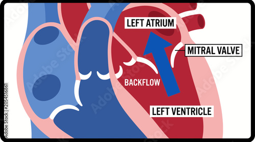 Εκτύπωση καμβά Mitral Valve Regurgitation Backflow Arrow Diagram