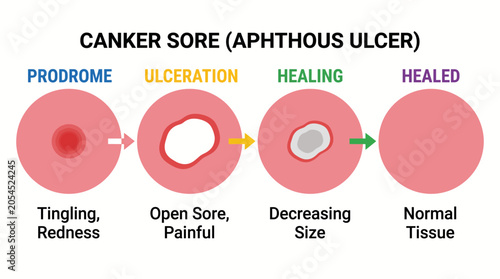 Quadro su tela Canker Sore Aphthous Ulcer Stages Diagram