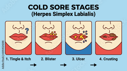 Bild auf Leinwand Cold Sore Herpes Simplex Labialis Stages