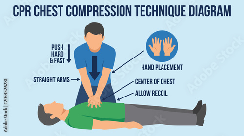 Tableau sur toile Cardiopulmonary Resuscitation CPR Chest Compression Technique Diagram