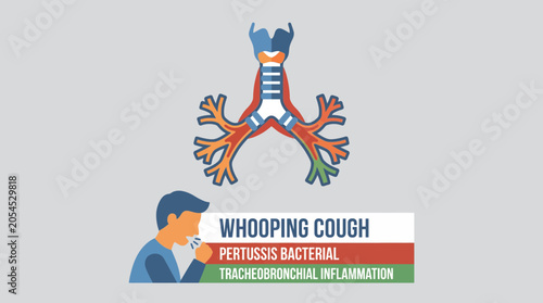 Tablou pe pânză Whooping Cough Pertussis Bacterial Tracheobronchial Inflammation